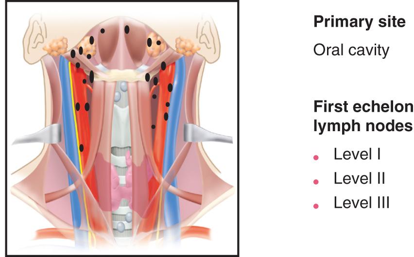 Figure 11.7, The first-echelon lymph nodes at highest risk for early dissemination by metastatic cancer from primary tumors in the oral cavity.