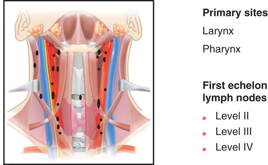 Figure 11.8, The first-echelon lymph nodes at highest risk for micrometastasis in a neck with clinically negative findings from primary tumors of the hypopharynx and larynx.