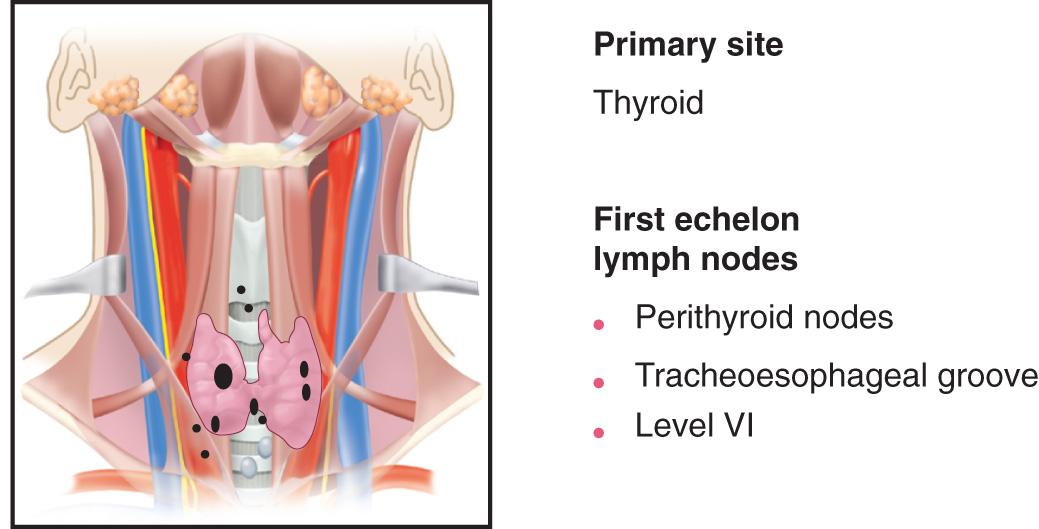 Figure 11.9, The first-echelon lymph nodes at highest risk for micrometastasis in a neck with clinically negative findings from a primary carcinoma of the thyroid gland.