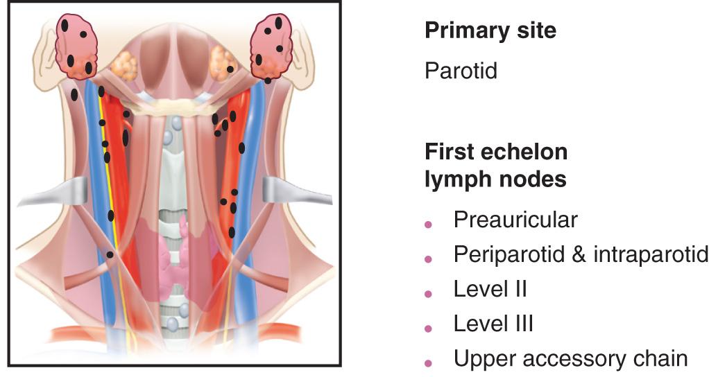 Figure 11.10, The first-echelon lymph nodes at highest risk for dissemination of metastatic cancer from a carcinoma of the parotid gland are in the periparotid and upper cervical region.