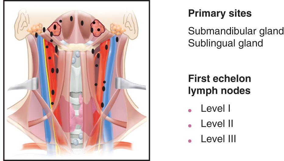 Figure 11.11, The initial dissemination of metastatic cancer from primary malignant tumors of the submandibular and sublingual salivary glands occurs at lymph nodes in the supraomohyoid triangle.