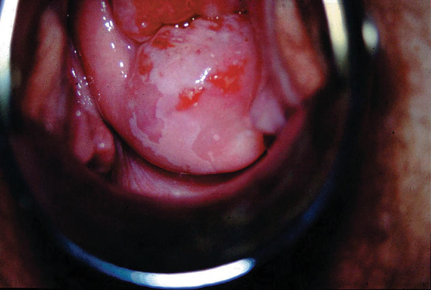 Fig. 14.7, Acetic acid coagulates protein and the abnormal cells, which have more protein, appear ‘aceto-white’ .
