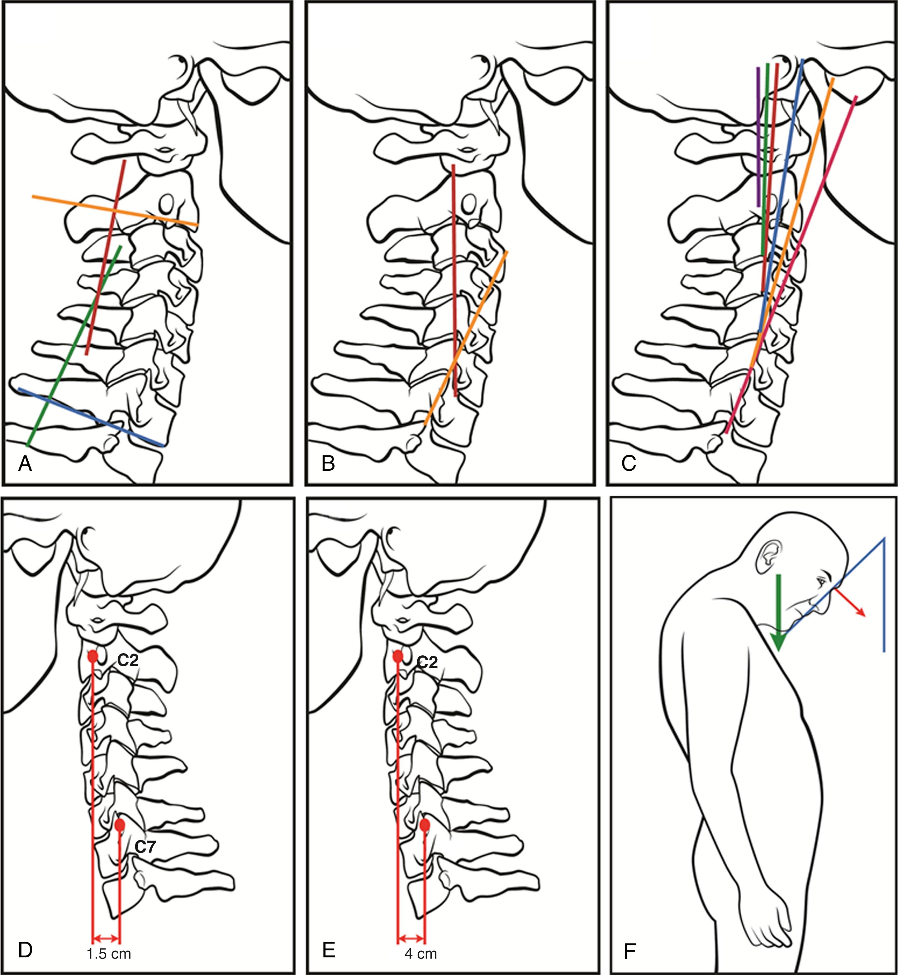 FIGURE 171.1, (A–C) Illustrations showing the different methods of measuring cervical lordosis: (A) the Cobb method; (B) the Jackson physiologic stress line method; (C) the Harrison posterior tangent method. (D and E) Illustrations showing the measurement of the cervical sagittal vertical axis: (D) a normal cervical sagittal vertical axis (cSVA); (E) an increased cSVA. (F) Illustration showing the method of measuring the chin brow vertical angle.