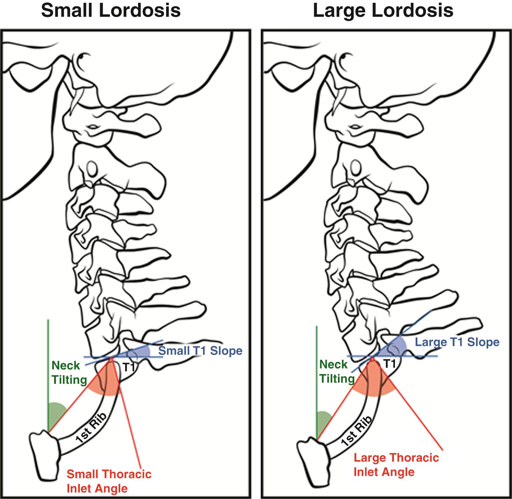 FIGURE 171.2, Illustration showing the relationship between T1 slope and thoracic inlet angle. The T1 slope is a compensatory mechanism the body uses to compensate for changes to increases in the thoracic inlet angle, which is a fixed parameter.