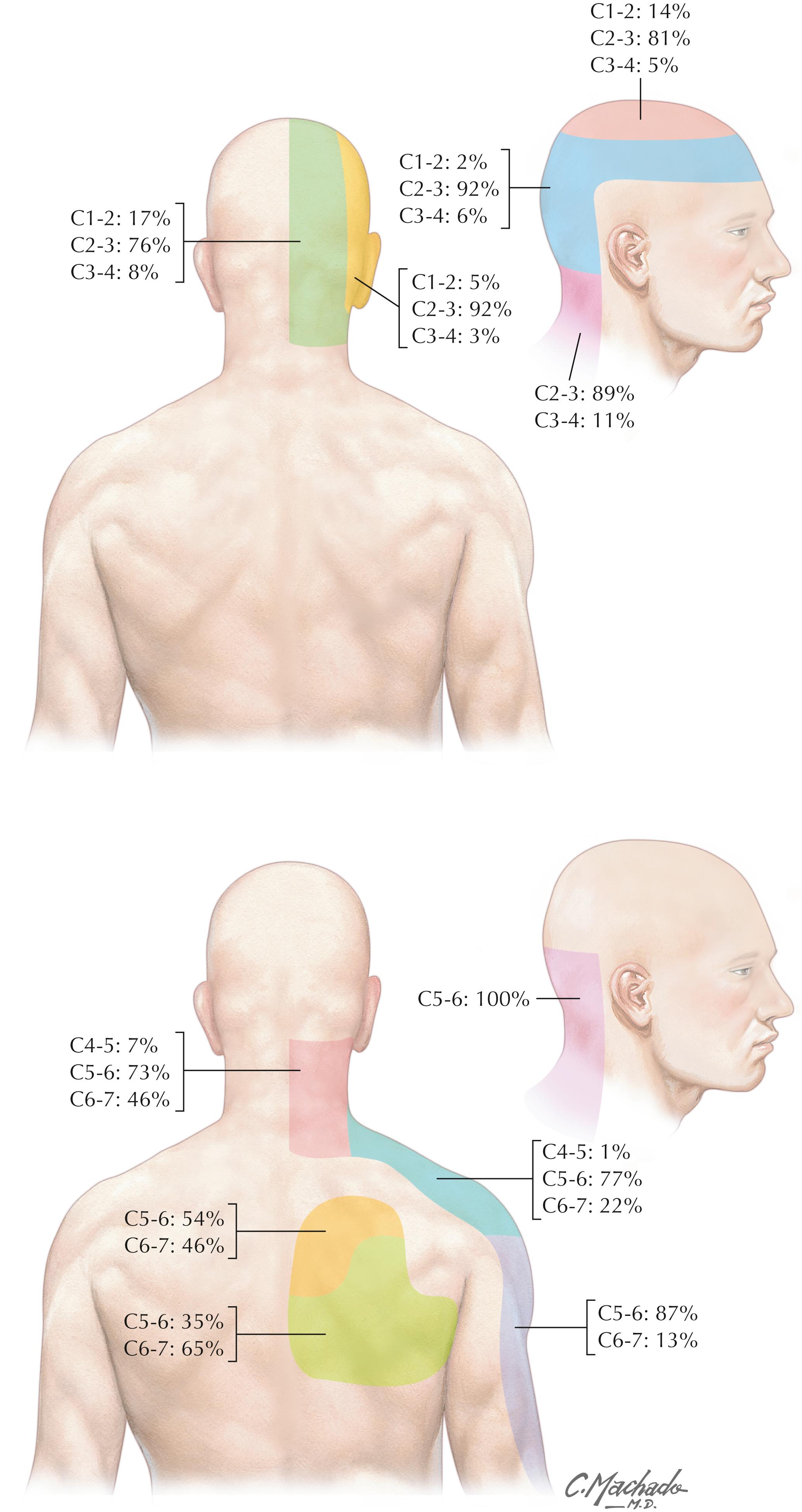 Figure 3-12, Pain referral patterns. Probability of zygapophyseal joints at the segments indicated being the source of pain, as described by Cooper and colleagues. 5