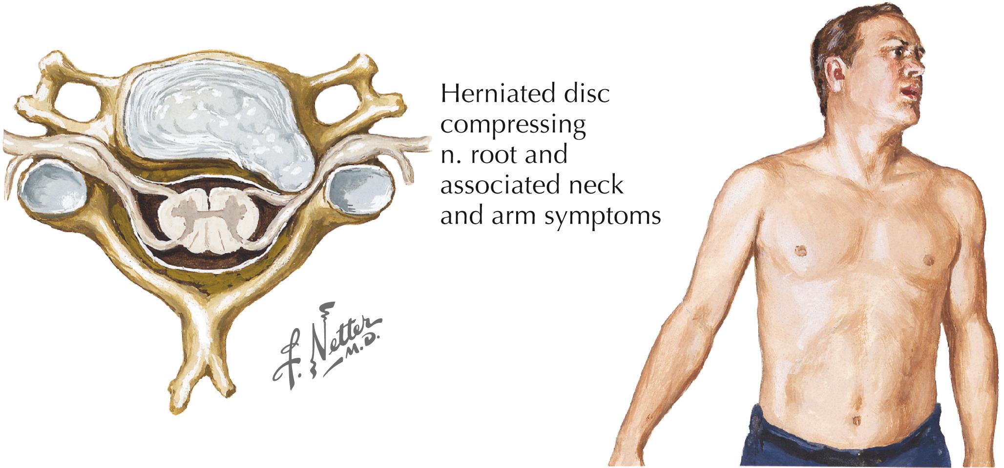 Figure 3-13, Cervical radiculopathy.