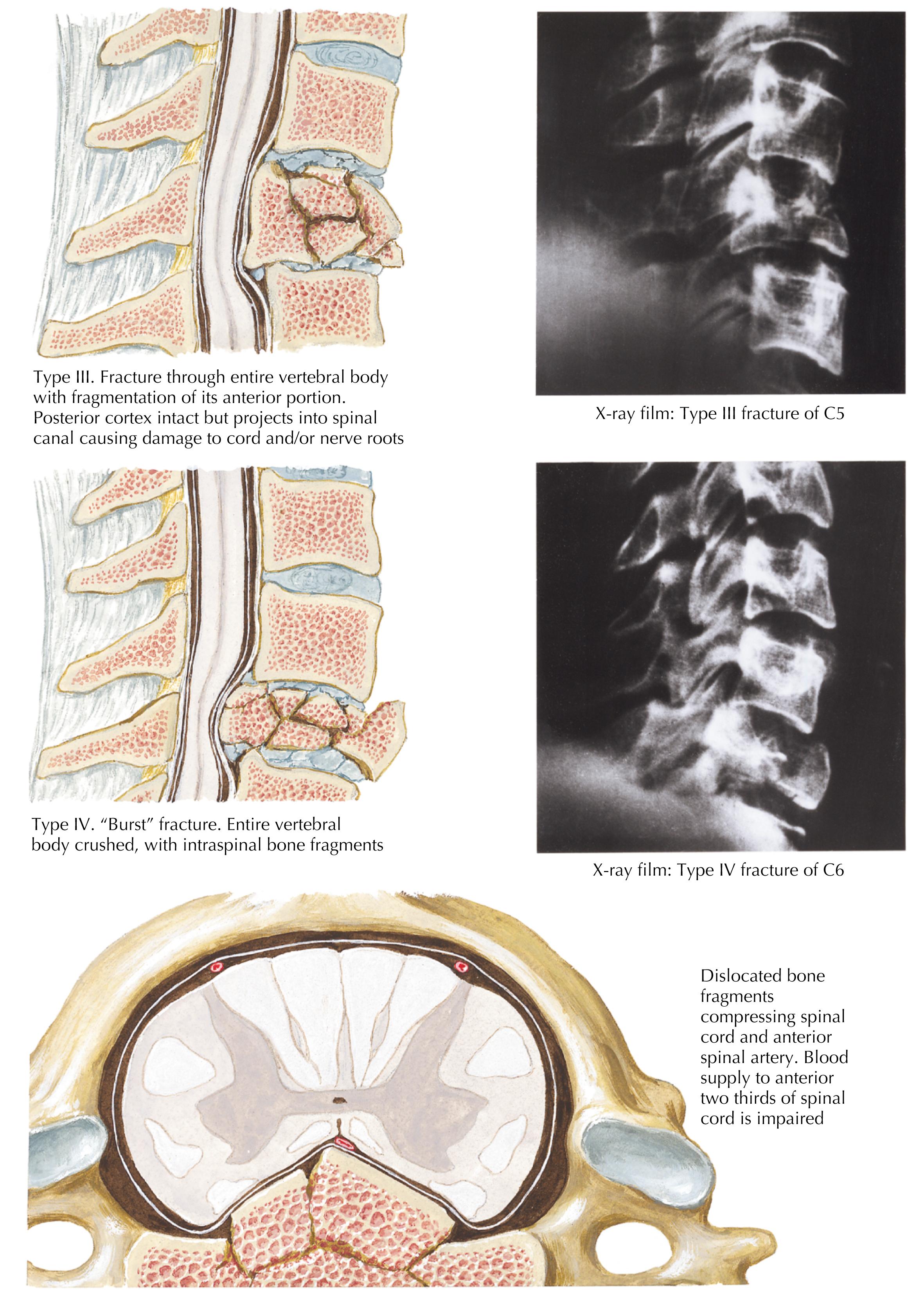 Figure 3-17, Compression fracture of the cervical spine.