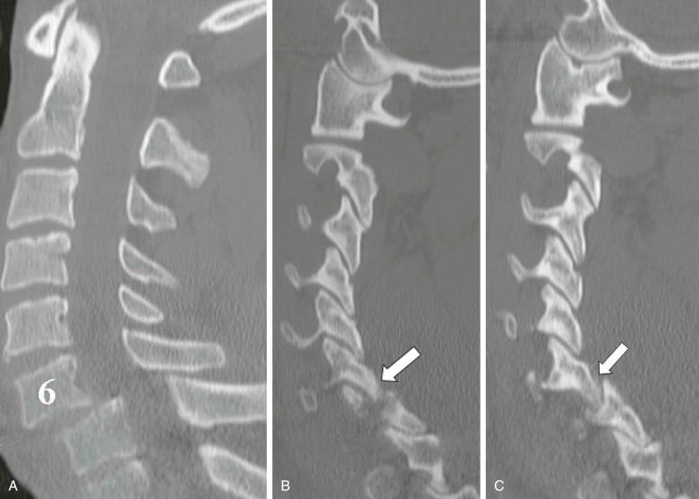 FIGURE 4–7, A 38-year-old man presented with hyperflexion injury. Midline ( A ), right ( B ), and left ( C ) sagittal reconstructed CT images show anterolisthesis of C6 on C7 with bilateral facet lock ( thick arrows , B and C ). Note the loss of imbrication of the facets.