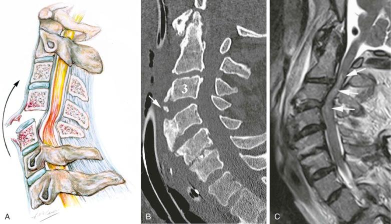 FIGURE 4–8, Extension injury. A , Drawing shows mechanism and injury. There is a small avulsion from the anterosuperior margin of the vertebra immediately below the affected level. Note the wide disk space and retrolisthesis, hallmarks of this injury. The spinal cord is frequently injured in this setting. B , Sagittal reconstructed CT image shows widening of the C3 disk space with an avulsed fragment of bone (arrow) and retrolisthesis. C , T2-weighted MR image shows cord hemorrhage (arrows) . The patient is quadriplegic.