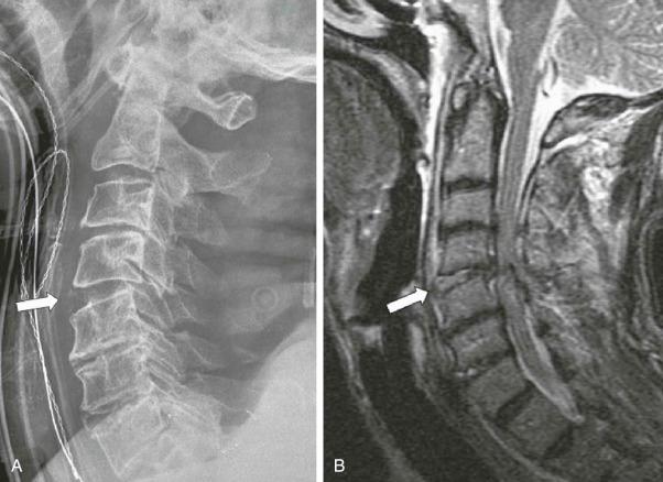 FIGURE 4–9, Hyperextension sprain in an elderly patient. A , Lateral radiograph shows retrolisthesis of C4 on C5 with widening of the anterior disk space (arrow) and narrowing of the posterior disk space. B , Sagittal fat-suppressed T2 MR image shows high T2 signal within the anterior disk space and injury of the anterior longitudinal ligament (arrow) .