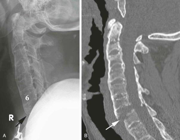 eFIGURE 4–5, 37-year-old man presented with ankylosing spondylitis after a motor vehicle accident. A , Initial lateral radiograph of the cervical spine demonstrates diffuse syndesmophytes related to the patient's ankylosing spondylitis. The syndesmophyte chain is interrupted at C7 (arrow) . B , Sagittal reconstructed CT image shows a fracture line through the anterior syndesmophyte at C7 (arrow) and extension through the C7 vertebral body. Fractures in these patients can be difficult to visualize on radiographs; therefore, CT should be obtained in all patients with ankylosing spondylitis after trauma.