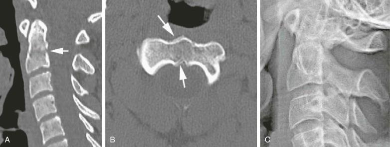 eFIGURE 4–6, Pseudofracture due to motion artifact. A , Sagittal reconstructed CT image shows a horizontal lucency (arrow) at the base of the dens. B , Axial CT image shows the motion along the margins (arrows) . C , Lateral radiograph shows no fracture. The soft tissues were normal.