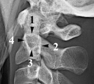 eFIGURE 4–4, Normal lateral cervical radiograph showing the four components of Harris' ring. 1, Superior articular facet; 2, posterior vertebral body line; 3, inferior margin of transverse foramen; 4, portion of anterior vertebral body.