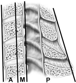 FIGURE 4–2, Biomechanically the spine is divided into three columns ( A, anterior; M, middle; P, posterior). The middle column functions as a fulcrum between two adjacent vertebrae.