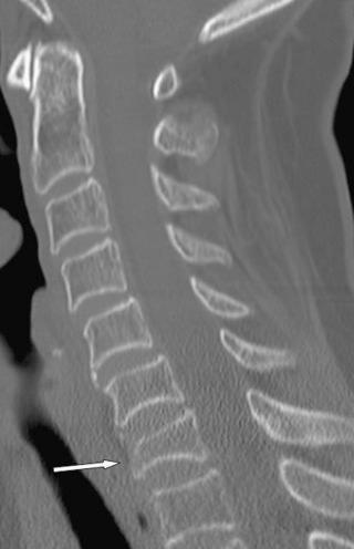 FIGURE 4–3, Simple compression fracture in a 72-year-old woman involved in a motor vehicle accident. Reformatted sagittal CT shows the C7 vertebral body compression fracture (arrow) with loss of vertebral body height anteriorly.