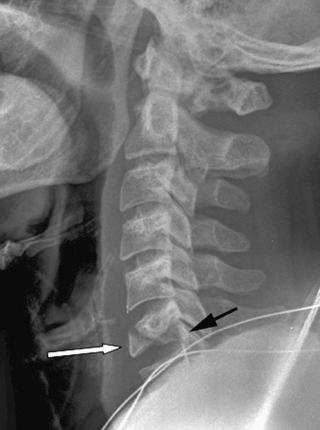 FIGURE 4–4, Burst of C6 in a 40-year-old man. There is a triangular fracture fragment (white arrow) arising from the anterior inferior margin of C6. The vertebral body demonstrates overall height loss, and there is a retropulsed fragment (black arrow) .