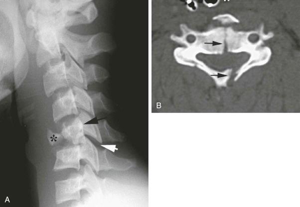 FIGURE 4–5, Flexion teardrop injury. This is a form of burst fracture. A , Radiograph shows an anterior teardrop fragment (asterisk) , retropulsion of bone into the vertebral canal (black arrow) , and widening of the facet joint (white arrow) . B , Axial CT image shows the sagittal fractures (arrows) through the body and lamina.