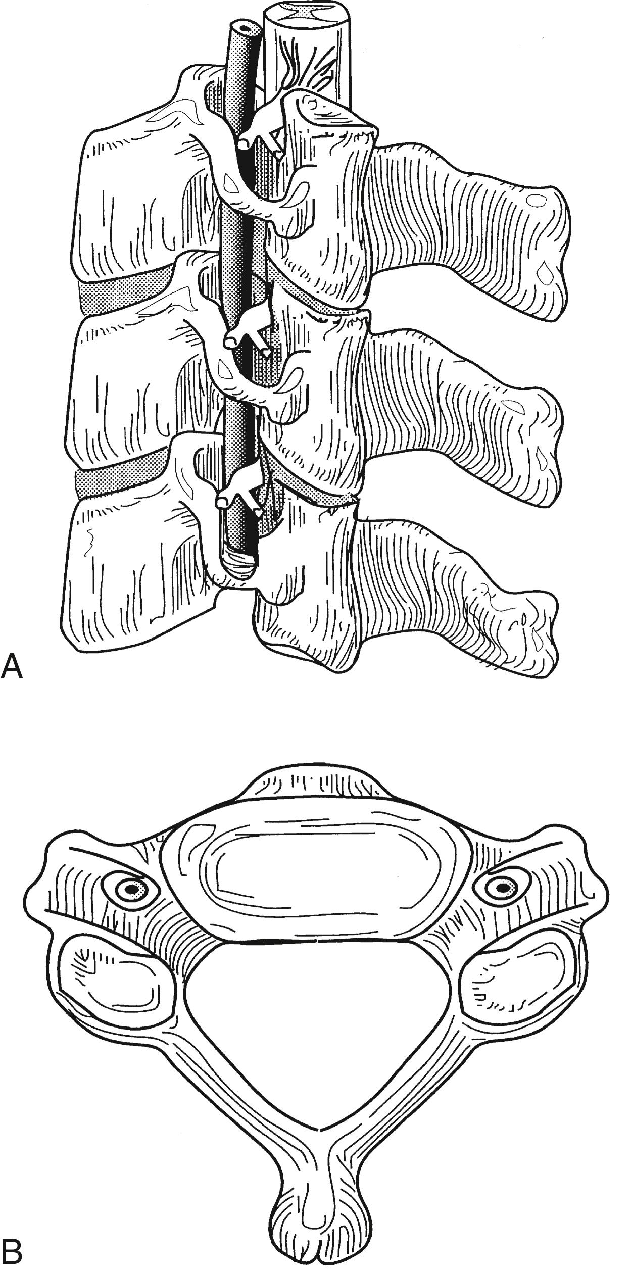 Figure 104.3, The subaxial spine. A, Lateral view. B, Axial view.