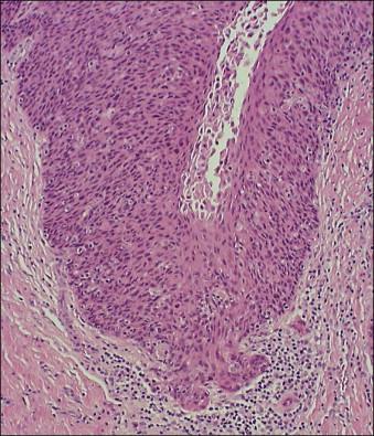 Figure 11.1, Microinvasive carcinoma. A tiny focus of stromal invasion that is barely perceptible arises from an extensive HSIL that fills an endocervical gland.