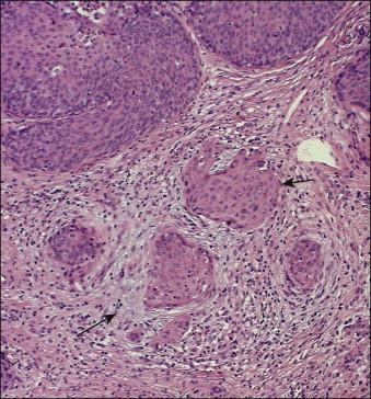 Figure 11.2, Microinvasive carcinoma. A focus of stromal invasion (arrows) that is separated by <1 mm from the overlying HSIL. In this instance multiple small tumor nests are totally separated from the surface epithelium.