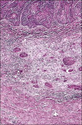 Figure 11.3, Microinvasive carcinoma, spray bud pattern. At high magnification, numerous clusters composed of small numbers of tumor cells are present in a desmoplastic stroma with a mild inflammatory infiltrate. Stromal retraction secondary to processing artifact creates the false impression of lymphovascular space invasion.