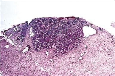 Figure 11.4, Microinvasive carcinoma, confluent pattern. The depth of invasion is slightly greater than 3 mm so this tumor is staged as FIGO stage IA2.