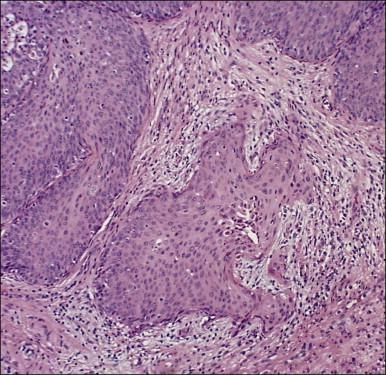 Figure 11.5, Microinvasive carcinoma. The invasive foci have an irregular or ‘scalloped’ margin that clearly distinguishes it from the sharp margin of the adjacent HSIL.