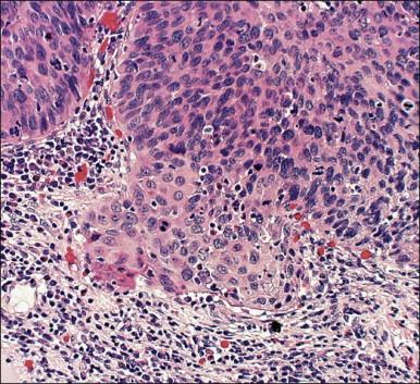 Figure 11.6, Microinvasive carcinoma. Cells in the invasive foci have developed abundant eosinophilic cytoplasm compared to the adjacent HSIL. Individual dyskeratotic cells are present in the invasive foci.