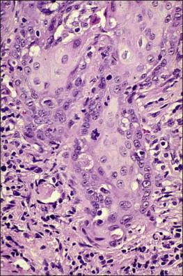 Figure 11.7, Microinvasive carcinoma. The nuclei of cells in the invasive foci show clearing of their chromatin and have developed prominent nucleoli.