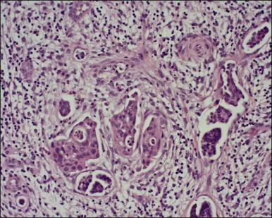 Figure 11.8, LVI in microinvasive carcinoma. Multiple foci of LVI are present at the leading edge of this tumor. Sparse endothelial cells line many of the channels.