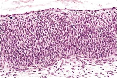 Figure 10.12, HSIL (CIN 3). Maturation is lacking throughout the entire thickness of the epithelium.