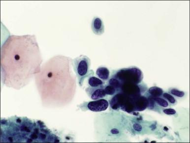 Figure 10.15, HSIL, severe dyskaryosis, on a cervical smear. The atypical cells have a high nuclear to cytoplasmic ratio.