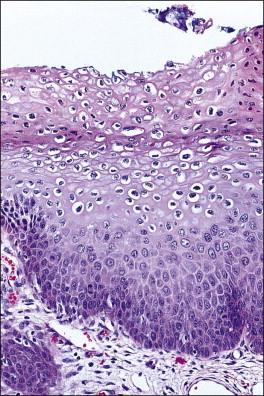 Figure 10.17, LSIL (CIN 1).