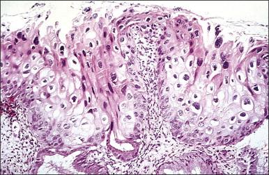 Figure 10.18, LSIL (CIN 1). There is prominent nuclear pleomorphism in koilocytes with extensive cytoplasmic maturation.