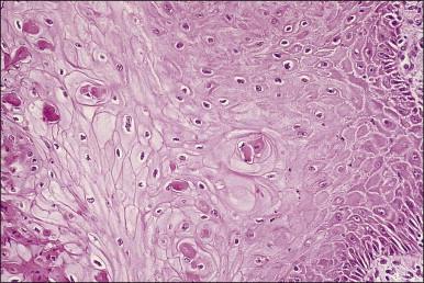 Figure 10.19, Focal individual cell dyskeratosis in LSIL (condyloma).