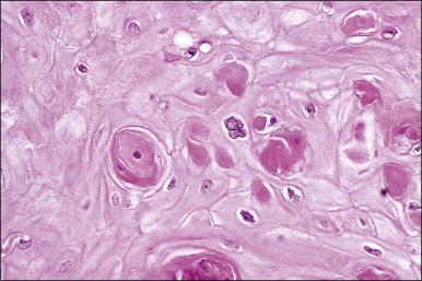 Figure 10.20, Focal individual cell dyskeratosis in LSIL (condyloma), detail.