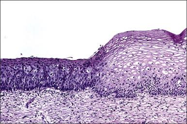 Figure 10.2, Abrupt transition between normal squamous epithelium (right) and an adjacent HSIL (left).