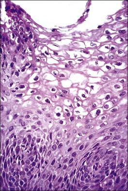 Figure 10.22, Koilocytes in LSIL (CIN 1).