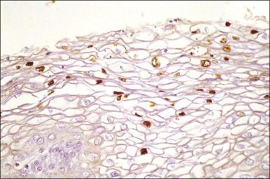 Figure 10.24, LSIL. Immunocytochemical staining shows viral capsid protein in koilocytes.