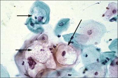 Figure 10.3, Koilocytes (arrows) in a cervical smear.