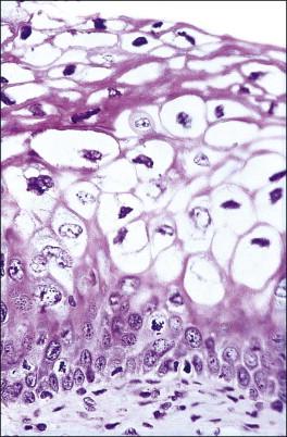 Figure 10.5, LSIL. The basal layer is slightly thickened. Koilocytes are prominent.