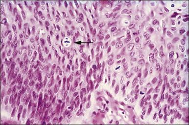 Figure 10.9, Three-group metaphase mitosis (arrow) in HSIL.