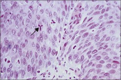 Figure 10.10, Tripolar mitosis (arrow) in HSIL.