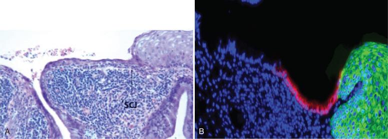 Fig. 13.1, The squamocolumnar junction (SCJ) and cervical neoplasia. A, Tissue section of the junction of the ectocervical (or mature metaplastic) epithelium with the endocervical mucosa. The arrow highlights the SCJ. B, Immunofluorescence for cytokeratin 7 (CK7) of a comparable region in another cervix demonstrates intense staining of a cuboidal cell population at the junction of the ectocervix and endocervix. This population is postulated to be the origin of cervical squamous and columnar neoplasia.