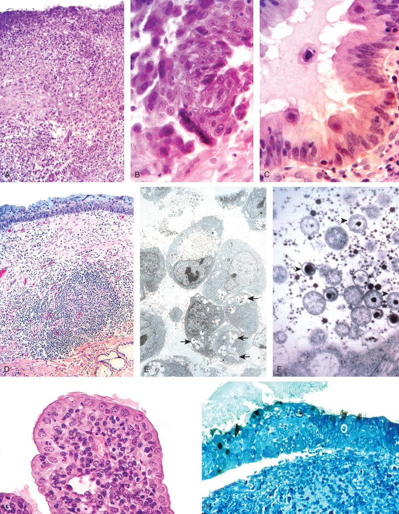 Fig. 13.12, Infections of the cervix that can be identified morphologically include: A, herpes simplex, presenting as an ulcer with epithelial necrosis and, B, intranuclear inclusions; C, cytomegalovirus, and, D, chlamydia, which may be associated with follicular cervicitis. E, Inclusions are best seen by electron microscopy (arrows). F, They contain primary and secondary particles (small and large arrowheads). By light microscopy, inclusions are extremely subtle (G), but may be identified by immunohistochemistry (H).