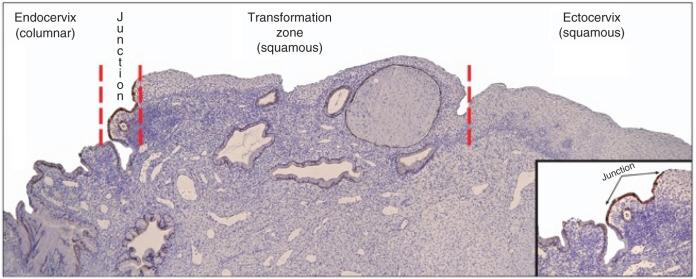 Fig. 13.13, Cytokeratin 7 (CK7)-stained section of the transformation zone and squamocolumnar junction (SCJ). Note there are four different epithelial “targets” for human papillomavirus (HPV) infection, including the ectocervix, metaplastic epithelium between the ectocervix and SCJ (transformation zone), the SCJ, and the endocervical epithelium. (From Herfs M, Yamamoto Y, Laury A, et al: A discrete population of squamocolumnar junction cells implicated in the pathogenesis of cervical cancer. Proc Natl Acad Sci USA 109:10516–10521, 2012.)