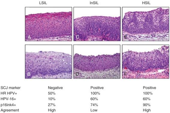 Fig. 13.15, Lesions emerging from the squamocolumnar junction (SCJ) and transformation zone may exhibit a range of histologies, and the origin of the lesion will influence histology and consequently, interpretation. A diagnosis of low-grade squamous intraepithelial lesion (LSIL) in the ectocervix (SCJ-) (A and B) can be made with good agreement. Similarly a diagnosis of high-grade squamous intraepithelial lesion (HSIL) (CIN2-3) in the SCJ (E and F, SCJ+) will have a high reproducibility. However, a subset of lesions in the SCJ will be more problematic (C and D), generating less agreement. We interpret these as lesions of uncertain or intermediate grade (CIN1-2). Associations with high-risk human papillomavirus (HR HPV), HPV-16 and p16 staining patterns are enumerated. What is clear is that any lesion arising in the SCJ is highly likely to contain high-risk HPV and be strongly positive for p16, yet may defy classification as either LSIL or HSIL. InSIL, Intermediate-grade squamous intraepithelial lesion.