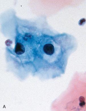 Fig. 13.5, Cytologic patterns often classified as atypical squamous cells of undetermined significance (ASCUS) include: A, cells bordering on low-grade squamous intraepithelial lesion (LSIL); B and C, mildly atypical maturing metaplastic cells; D, atypical parakeratotic cells; E, atypical metaplasia; F, atypical immature cells with a metaplastic phenotype; G, hyperchromatic clusters of cells with a high nuclear/cytoplasmic (N/C) ratio; and, H, degenerated atypical cells (less common with liquid-based preparations). A and D cannot be reproducibly distinguished from LSIL; B, C, and E are least impressive and might also be classified as reactive changes; F and G were associated with biopsy-proven high-grade squamous intraepithelial lesion (HSIL) and cervical carcinoma, respectively.