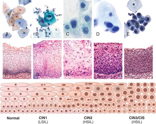 Fig. 13.6, A classic schematic of cervical intraepithelial neoplasia (CIN; lower) defines the cytopathologic (A-E) and histopathologic (F-J) transitions from normal to low-grade squamous intraepithelial lesion (LSIL) (cervical intraepithelial neoplasia grade 1 [CIN1] ) to high-grade squamous intraepithelial lesion (HSIL) (cervical intraepithelial neoplasia grade 2 [CIN2] /cervical intraepithelial neoplasia grade 3 [CIN3] ). This composite addresses the common aspects of histologic-cytologic correlation but does not take into account nuances of transformation zone differentiation that may further influence morphology (see Figs. 13.23 to 13.27 ). CIS, Carcinoma in situ.