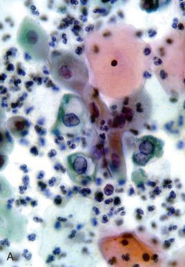 Fig. 13.9, Cytologic mimics of squamous intraepithelial lesion (SIL). A, Menopausal karyomegaly with cytoplasmic halos mimics a low-grade squamous intraepithelial lesion (LSIL). Mimics of high-grade squamous intraepithelial lesion (HSIL) include, B and C, atrophic changes and, rarely; D, immature condyloma.